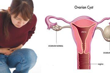 9 Ciri Kista Ovarium yang Perlu Diketahui Wanita